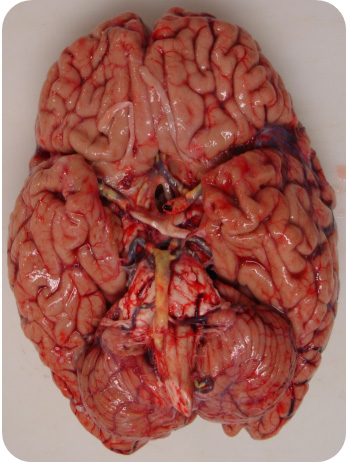 Figura-3. Macroscopía pre-fijación: Peso cerebro: 1.170 g.
Arterioesclerosis severa de arteria basilar y polígono de Willis.