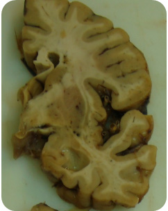 Figuras 4, 5 y 6. La flecha indica un infarto lacunar en el Putamen. La microscopía, revela una oquedad en el núcleo lenticular, rodeada de macrófagos.