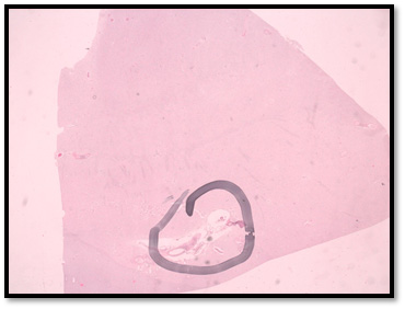 Figuras 4, 5 y 6. La flecha indica un infarto lacunar en el Putamen. La microscopía, revela una oquedad en el núcleo lenticular, rodeada de macrófagos.