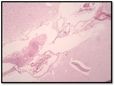 Figuras 4, 5 y 6. La flecha indica un infarto lacunar en el Putamen. La microscopía, revela una oquedad en el núcleo lenticular, rodeada de macrófagos.