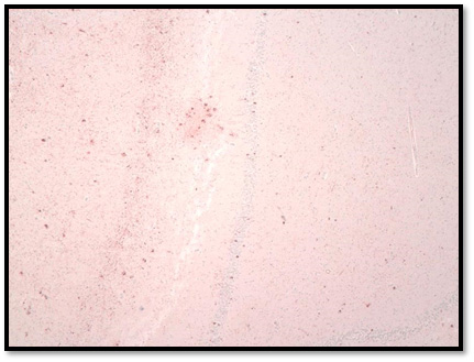 Figuras 7 y 8. Hipocampo anterior: Presencia de tangles y pre-tangles y tangles en el marcaje de la proteína Tau (AT8).