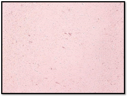 Figuras 7 y 8. Hipocampo anterior: Presencia de tangles y pre-tangles y tangles en el marcaje de la proteína Tau (AT8).