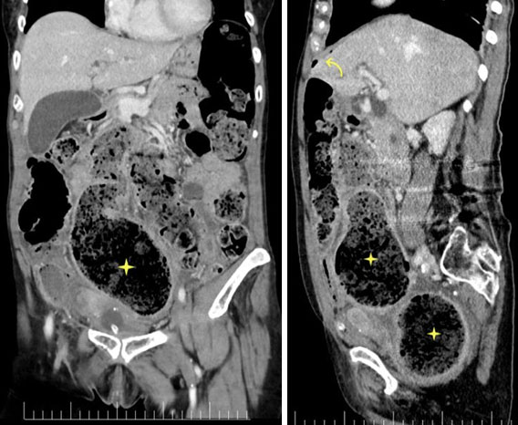 Fig. 1 y 2: reconstrucción coronal y sagital de TAC: distensión de sigma ocupado por heces (asterisco) y neumoperitoneo (flecha).